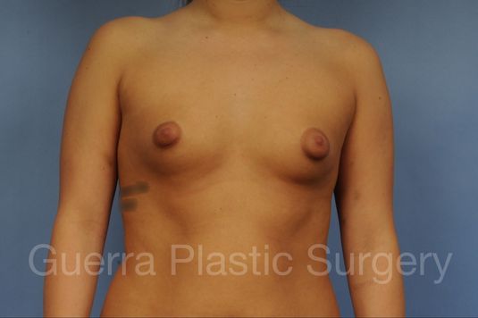 Case #1001204 Before