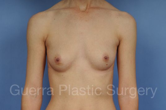 Case #1001206 Before