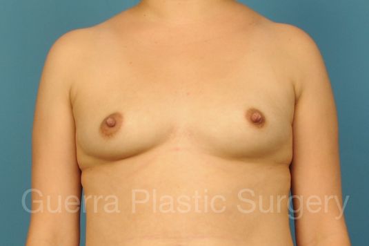 Case #1001207 Before