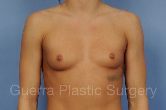 Case #1001209 Before