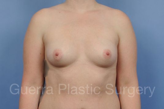 Case #1001210 Before