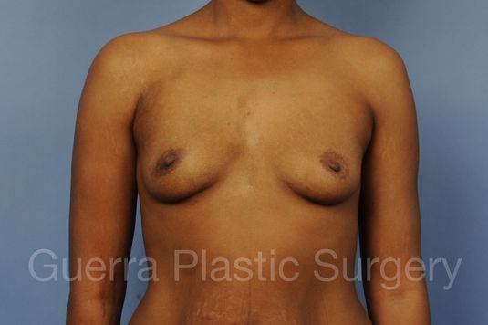 Case #1001211 Before