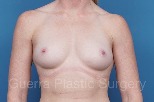 Case #1006005 Before