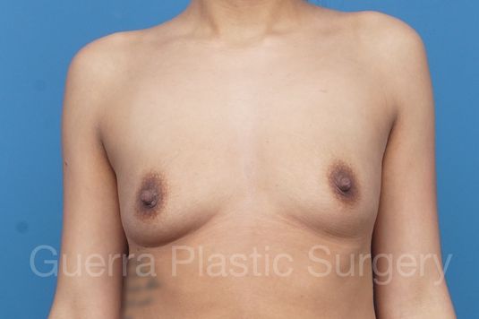 Case #1006007 Before