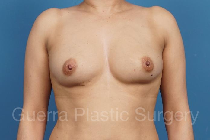 Before Photo Breast Augmentation