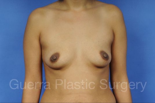 Case #1001001 Before