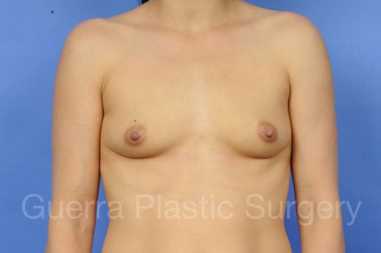 Case #1001008 Before