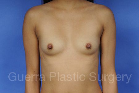 Case #1001011 Before