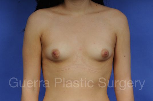 Case #1001013 Before