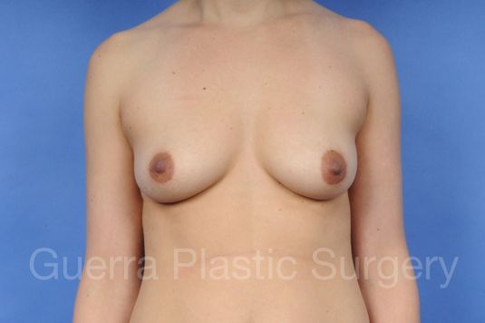 Case #1001021 Before