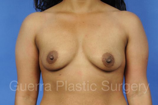 Case #1001023 Before