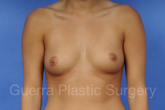 Case #1001025 Before