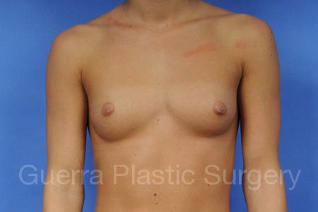 Case #1001026 Before