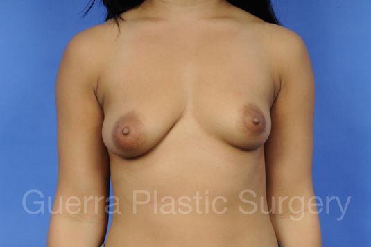 Case #1001035 Before