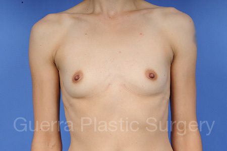 Case #1001038 Before