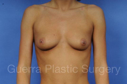 Case #1001041 Before