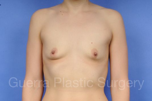 Case #1001043 Before