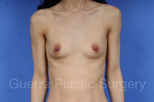 Case #1001045 Before