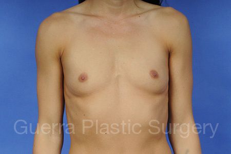 Case #1001046 Before