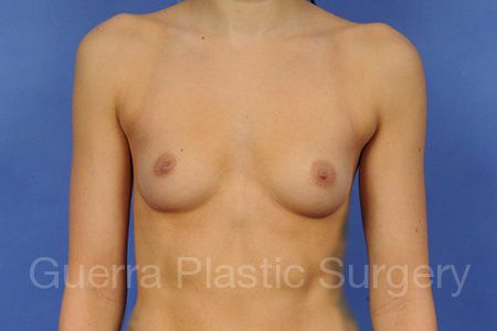 Case #1001049 Before