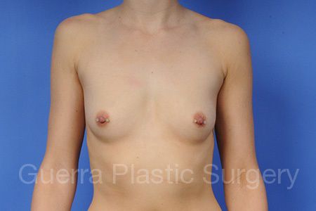 Case #1001056 Before