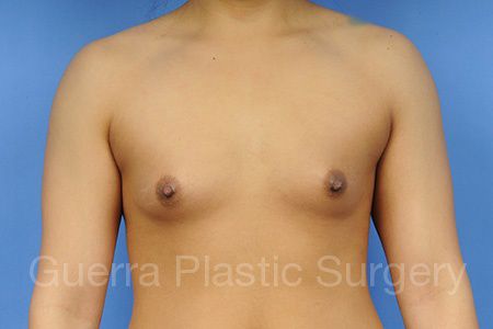 Case #1001059 Before