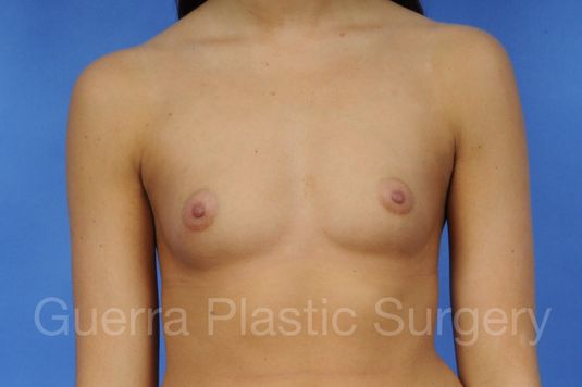 Case #1001062 Before