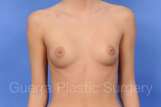 Case #1001067 Before