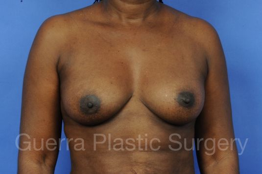 Case #1001071 Before