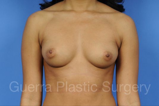 Case #1001079 Before