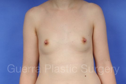 Case #1001089 Before