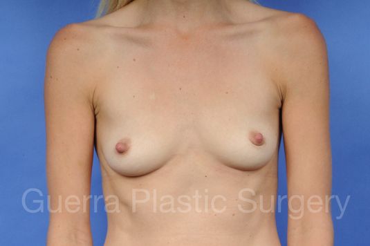 Case #1001091 Before