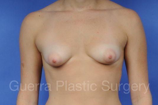 Case #1003002 Before