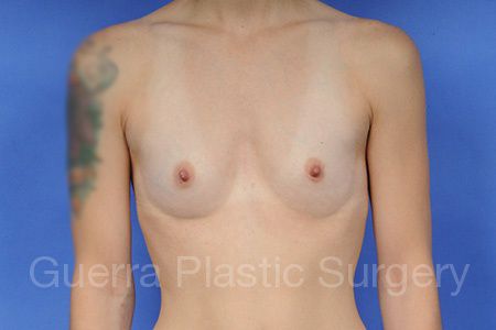 Case #1003003 Before