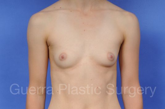 Case #1003007 Before