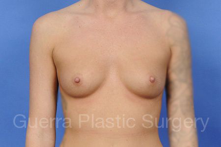 Case #1003013 Before