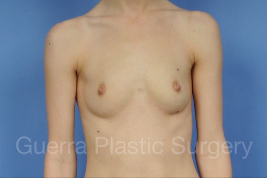 Case #1002007 Before