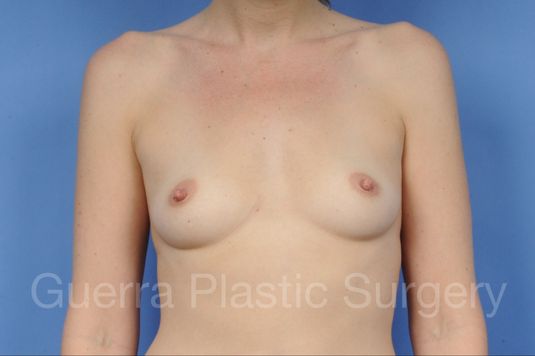 Case #1002016 Before