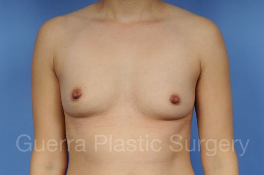 Case #1002011 Before