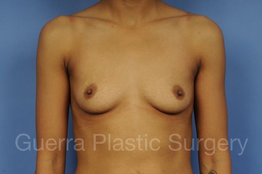 Case #1002029 Before