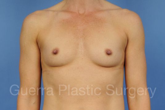 Case #1002012 Before