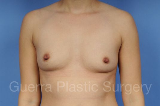 Case #100201104 Before