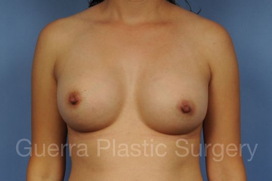 Case #100201104 After