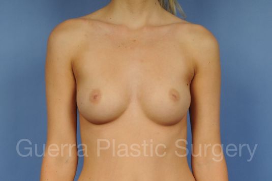 Case #1003015 Before