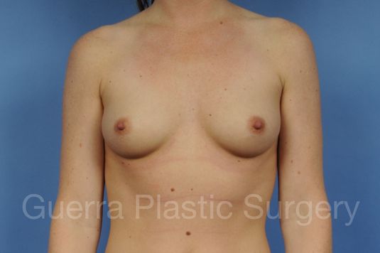 Case #1001120 Before