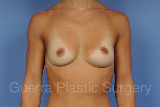 Case #1002047 Before