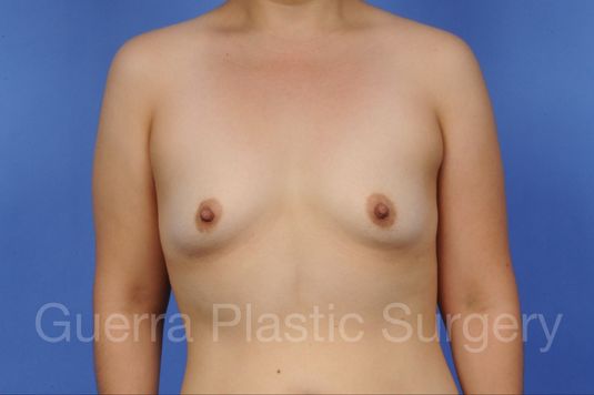 Case #1003016 Before