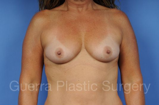 Case #1004004 Before