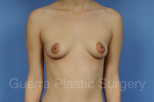 Case #1003017 Before