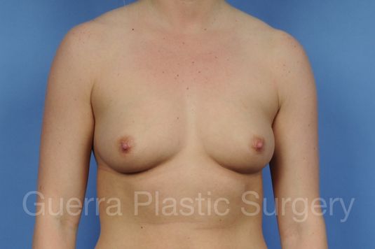 Case #1001093 Before